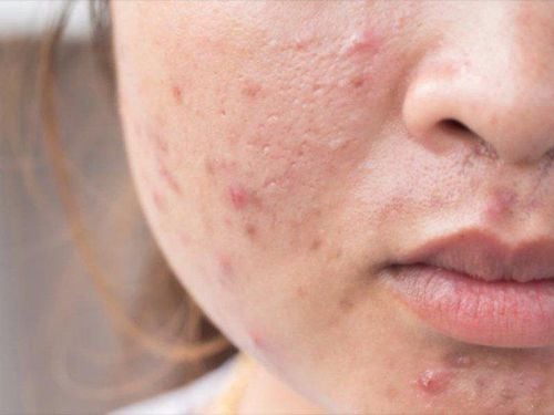 What should I do when I have acne?