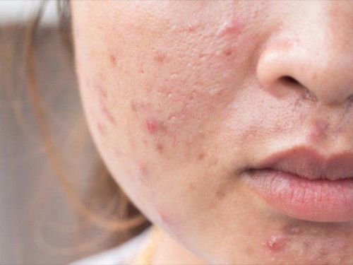 Visual images of acne