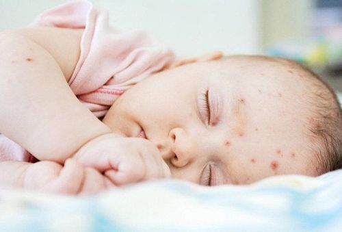 Hỏi đáp: Trẻ sơ sinh xuất hiện mụn đỏ có mủ là dấu hiệu viêm da phải không?