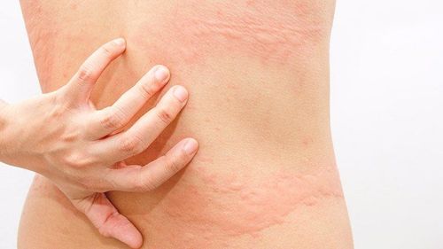 Choline urticaria: Causes, symptoms and treatment