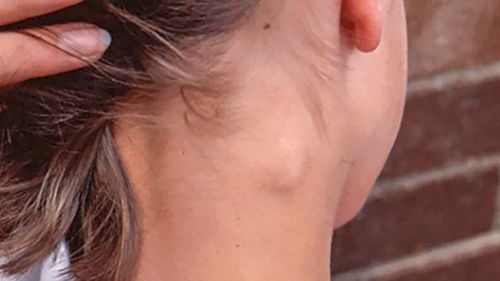 Trẻ bị nổi hạch sau mang tai là bệnh gì? Có đáng lo không?