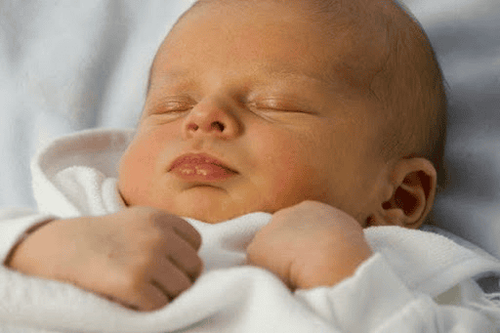 Jaundice due to indirect hyperbilirubinemia in neonates