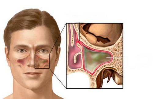 Phẫu thuật dây thần kinh Vidian chống chỉ định với bệnh nhân bị viêm xoang hàm mãn tính