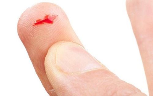  Is there a risk of HIV infection from an open wound that is contaminated with blood?