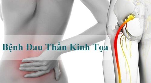 
Đau thần kinh tọa nằm đệm gì là thắc mắc của nhiều người bệnh
