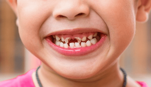 Trẻ sún răng, suy dinh dưỡng cần khắc phục thế nào?