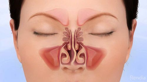 Is stuffy nose, difficulty breathing a sign of a deviated septum?