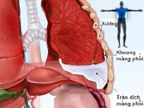 
Rút ống dẫn lưu được chỉ định sau quá trình điều trị tràn dịch màng phổi
