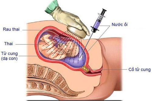 Mục đích truyền ối cho thai phụ thiểu ối