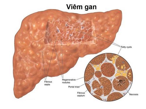 Nhu mô gan đậm âm là gì?