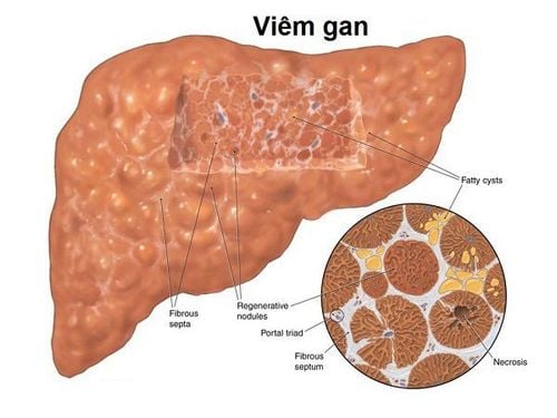 How many levels of fatty liver are there? How dangerous is it?