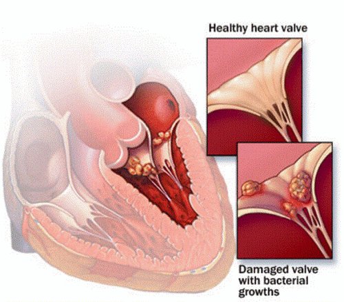 Infective endocarditis: Diagnosis and treatment