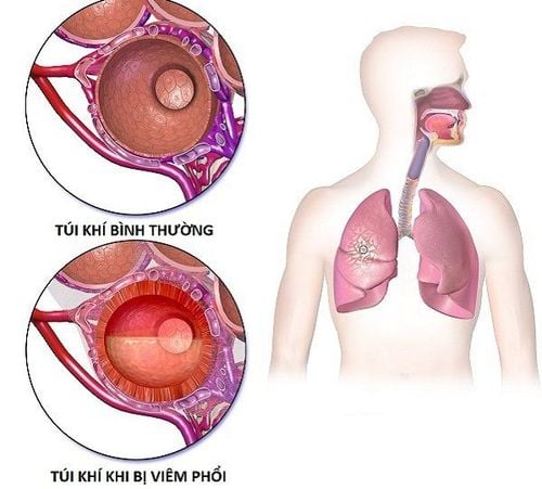 
Bệnh lý viêm phổi có thể gây tình trạng khó thở cho người bệnh
