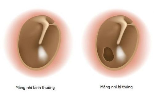 
Thủng màng nhĩ là biến chứng nguy hiểm từ việc xì mũi
