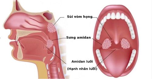 Injection of an abscess around the tonsil