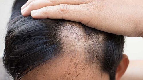 Rụng tóc do gen di truyền có cách nào khắc phục không?