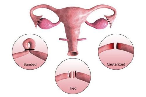 Does sterilization reduce sex drive?