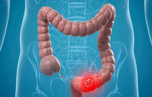 The relationship between polyps and colorectal cancer
