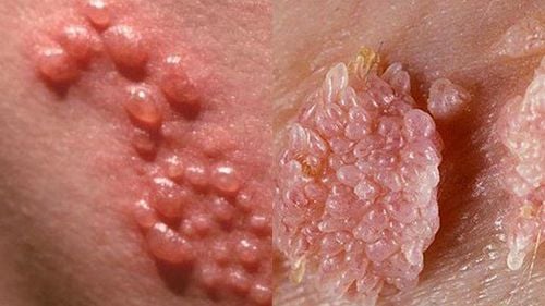 Can I get the HPV vaccine if I have genital warts?