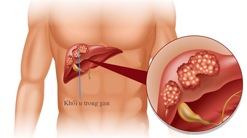 
Dấu ấn sinh học của ung thưu gan là Alpha-fetoprotein (AFP)
