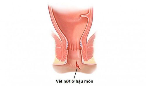 Emergency treatment of anorectal wounds