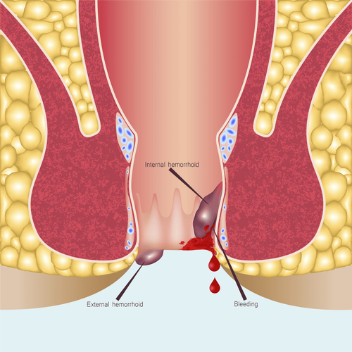 Having a history of hemorrhoids, having a lot of anal bleeding but no burning pain is it dangerous?