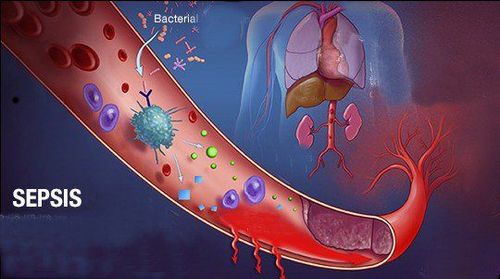 
Sepsis - tình trạng nhiễm trùng huyết trong y học
