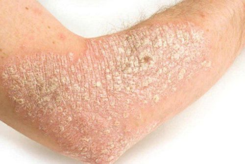 Note when using topical corticosteroid cream to treat psoriasis