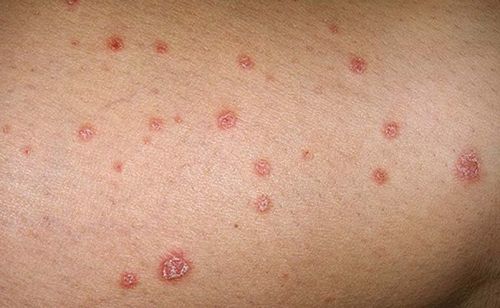 Psoriasis and the risk of type 2 diabetes