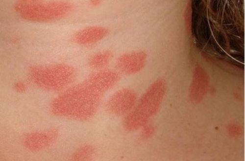 Pityriasis rosea and how to treat it