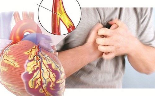 Bệnh động mạch vành có thể dẫn đến những cơn đau tim