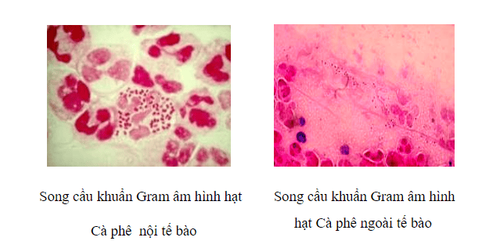 Fresh endoscopic test - white blood staining helps to detect the causative agents of vaginitis