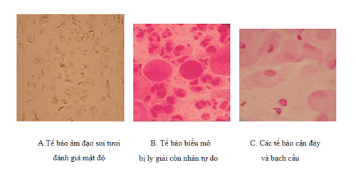 Fresh endoscopic test - white blood staining helps to detect the causative agents of vaginitis