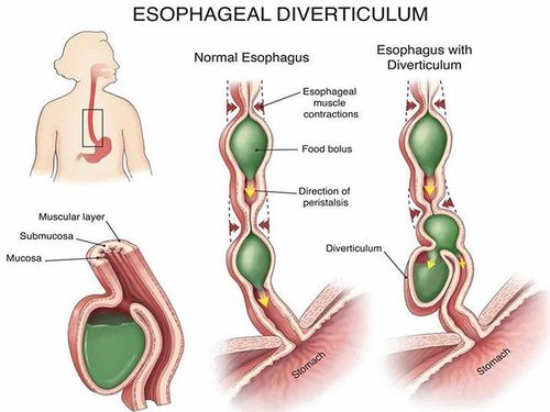 Ảnh hưởng của túi thừa thực quản