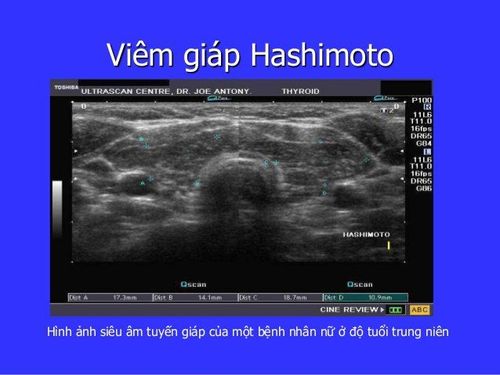 Viêm tuyến giáp Hashimoto phát hiện trên siêu âm
