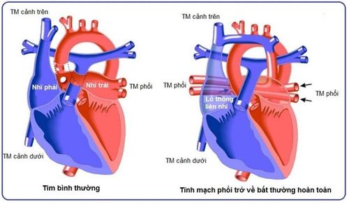 Phẫu thuật sửa tĩnh mạch phổi đổ lệch chỗ bán phần