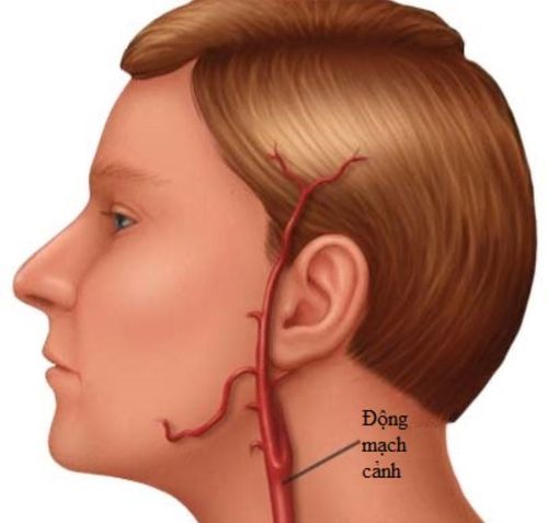 
Bệnh động mạch cảnh có thể áp dụng phương pháp điều trị là Nong và đặt stent
