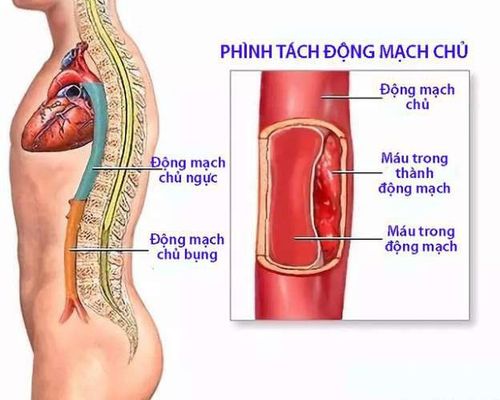 
Phình tách động mạch chủ là một nguyên nhân gây tràn máu màng ngoài tim
