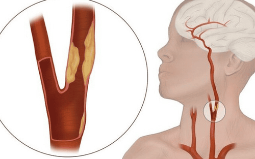 What is carotid artery? Common carotid artery diseases