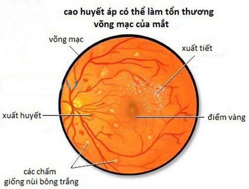 
Xuất huyết võng mạc là một triệu chứng điển hình của bệnh võng mạc trong tăng huyết áp
