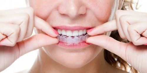 Tẩy trắng răng bằng máng: Những điều cần biết