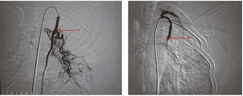 Digital erasure of the background and bronchial embolization