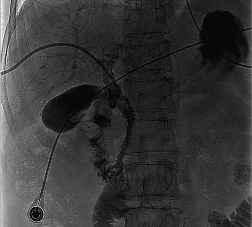 
Đặt stent đường mật qua da (PTBS) thường được sử dụng trong điều trị tắc đường mật ác tính.
