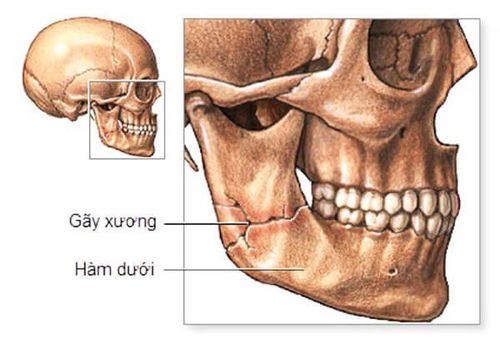 
Có nhiều dạng chấn thương hàm mặt khác nhau
