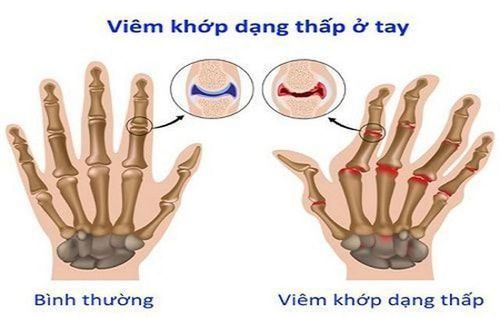 Drug use in the treatment of rheumatoid arthritis