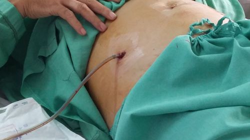 How will the fluid color be removed after laparoscopic appendectomy?