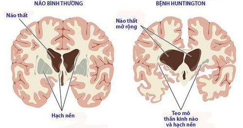 
Bố hoặc mẹ mang đột biến gen trội thì có thể con sẽ mắc bệnh Huntington
