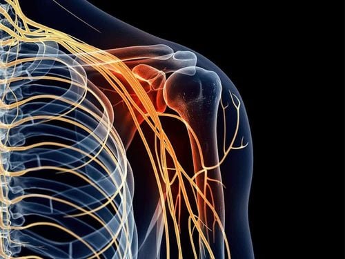 Anesthesia of brachial plexus under ultrasound guidance