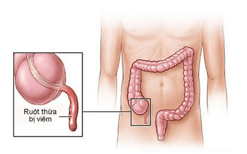 
Viêm phúc mạc toàn thể là nguyên nhân gây viêm ruột thừa
