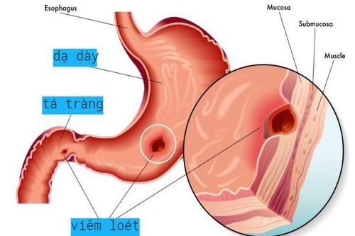 
Các vết viêm loét dạ dày gây ra những cơn đau âm ỉ hoặc dữ dội
